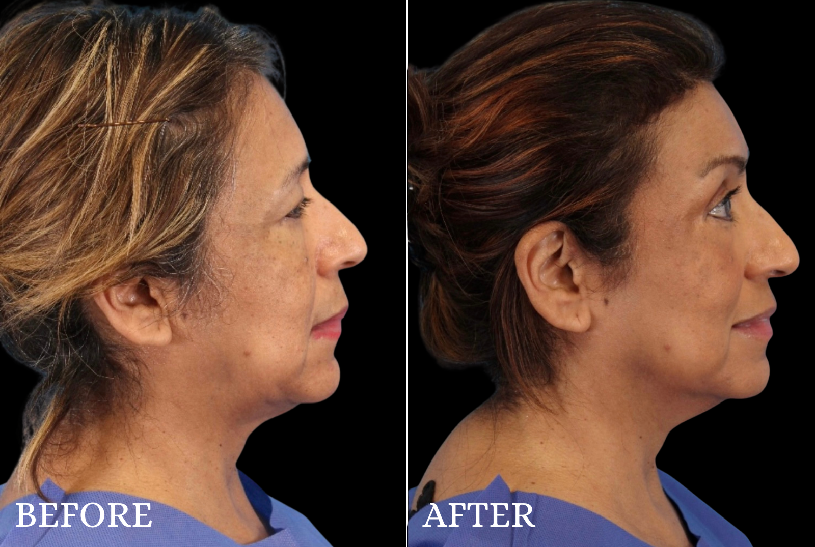 Upper Blepharoplasty Before & After Gallery - Patient 413112 - Image 4