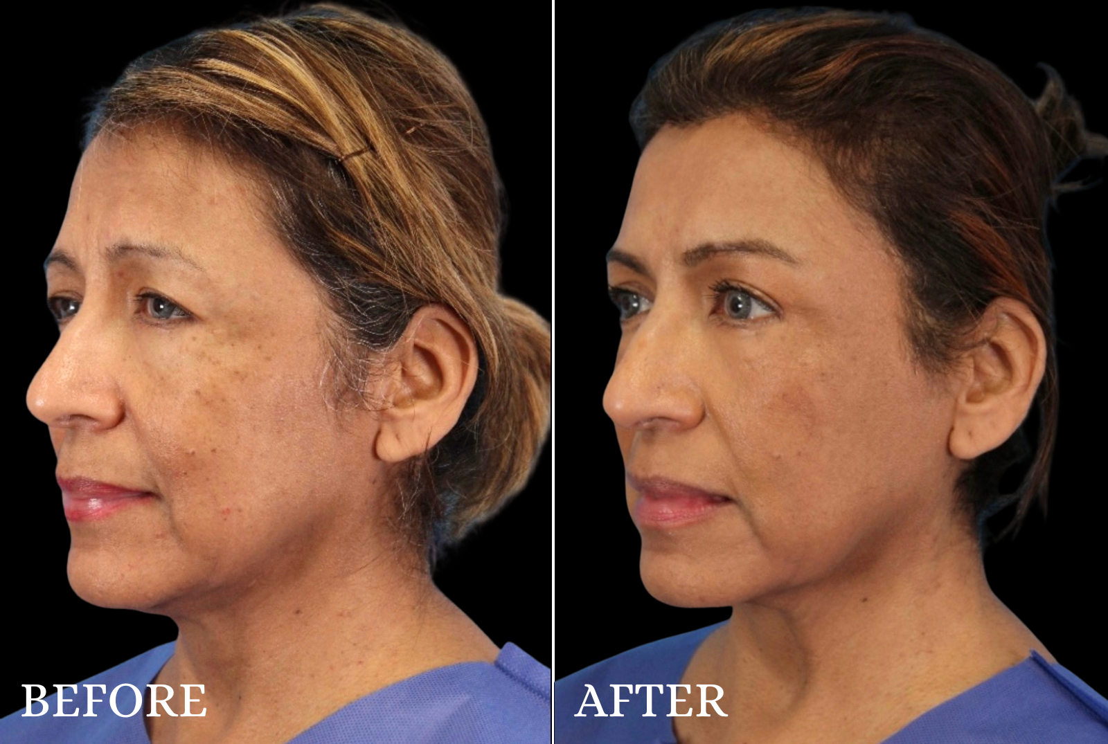 Upper Blepharoplasty Before & After Gallery - Patient 413112 - Image 2