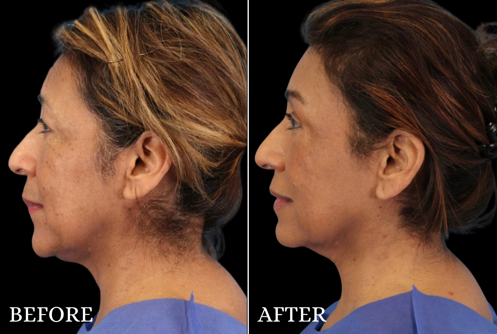 Upper Blepharoplasty Before & After Gallery - Patient 413112 - Image 3