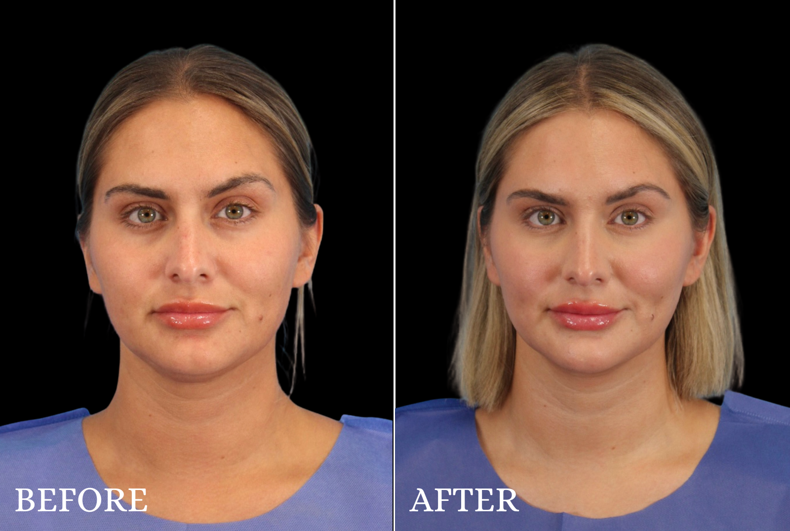 Chin Liposuction Before & After Gallery - Patient 290915 - Image 3