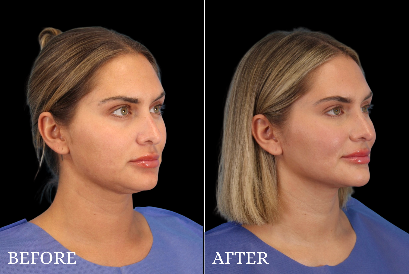 Chin Liposuction Before & After Gallery - Patient 290915 - Image 2
