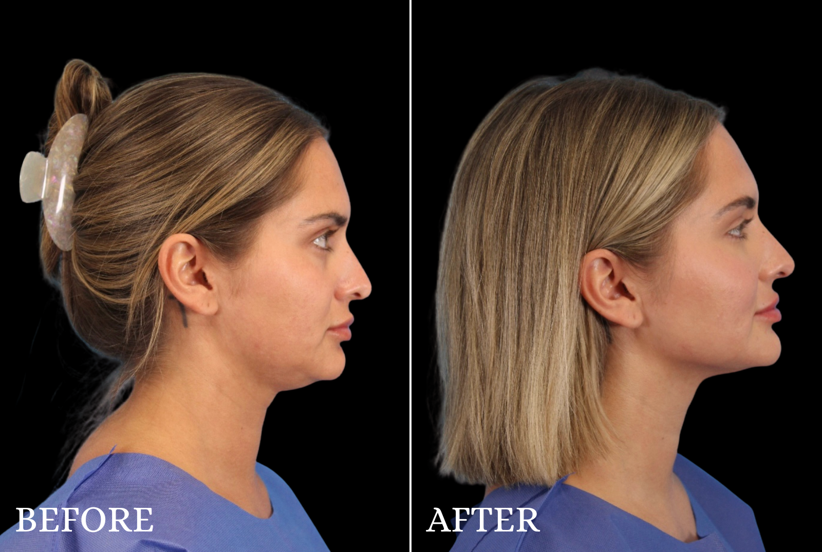 Chin Liposuction Before & After Gallery - Patient 290915 - Image 1