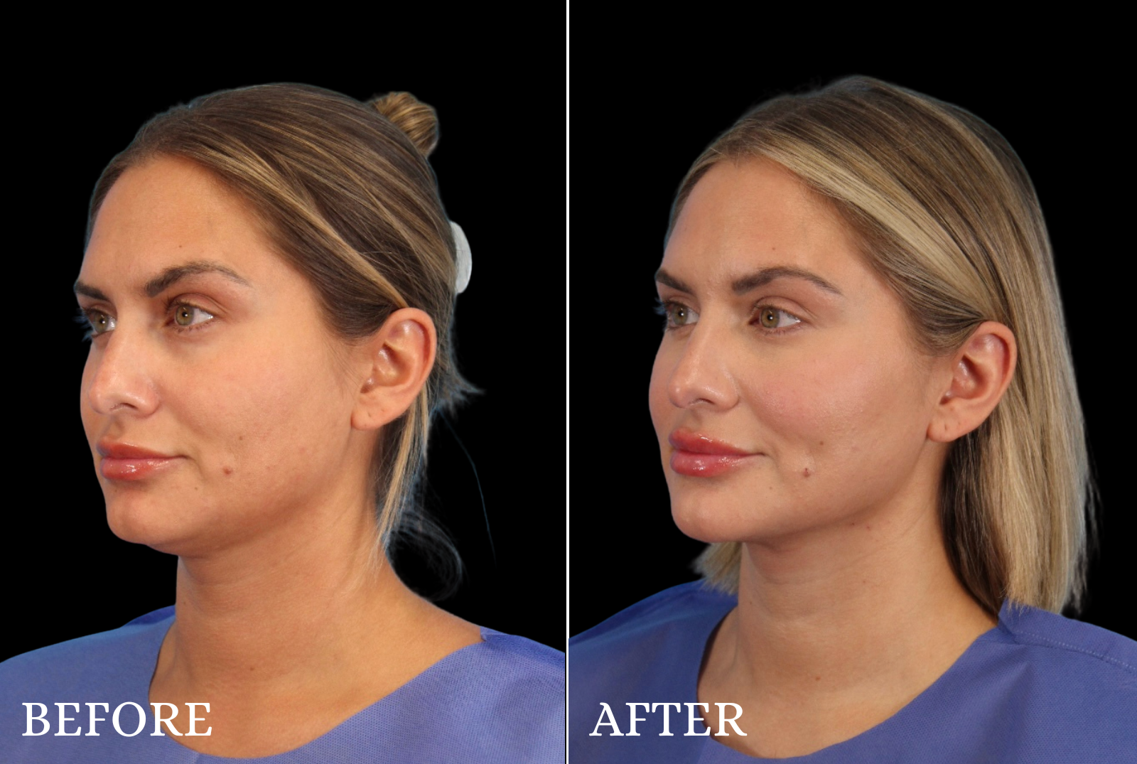 Chin Liposuction Before & After Gallery - Patient 290915 - Image 4