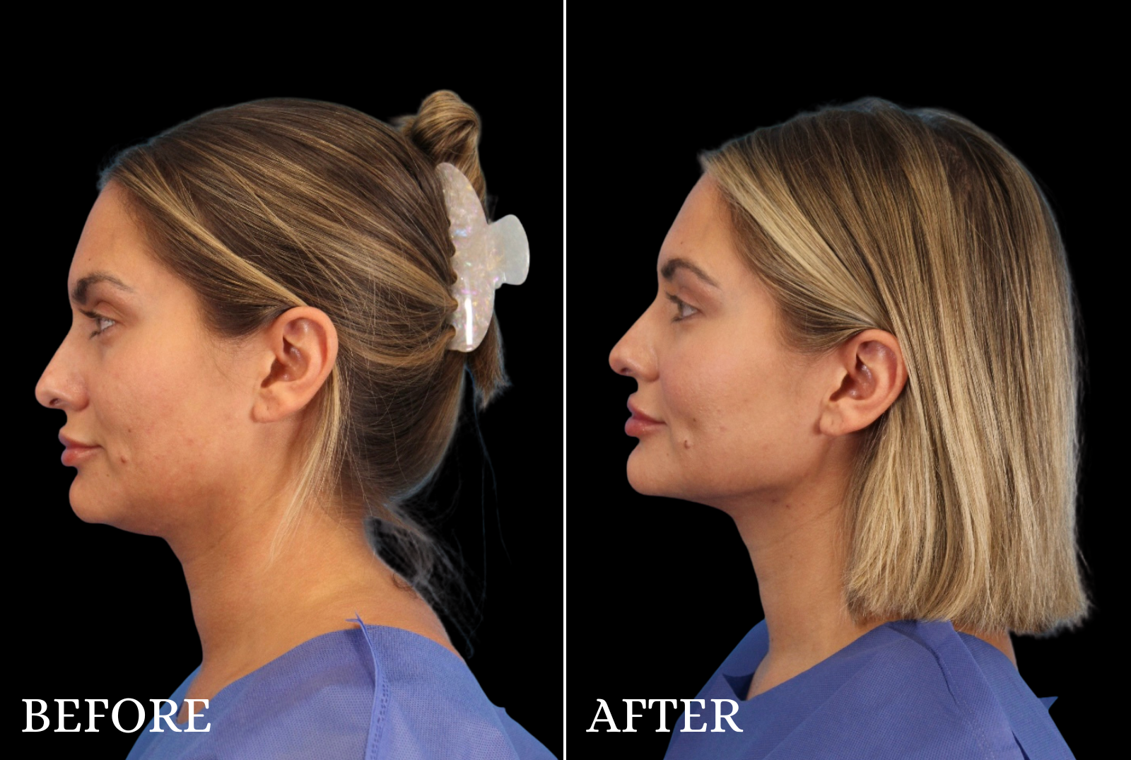 Chin Liposuction Before & After Gallery - Patient 290915 - Image 5