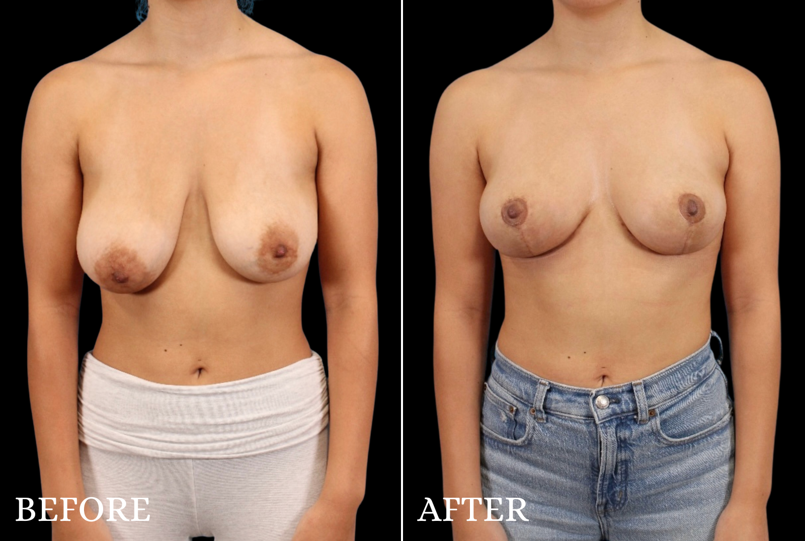 Breast Lift Before & After Gallery - Patient 389430 - Image 1