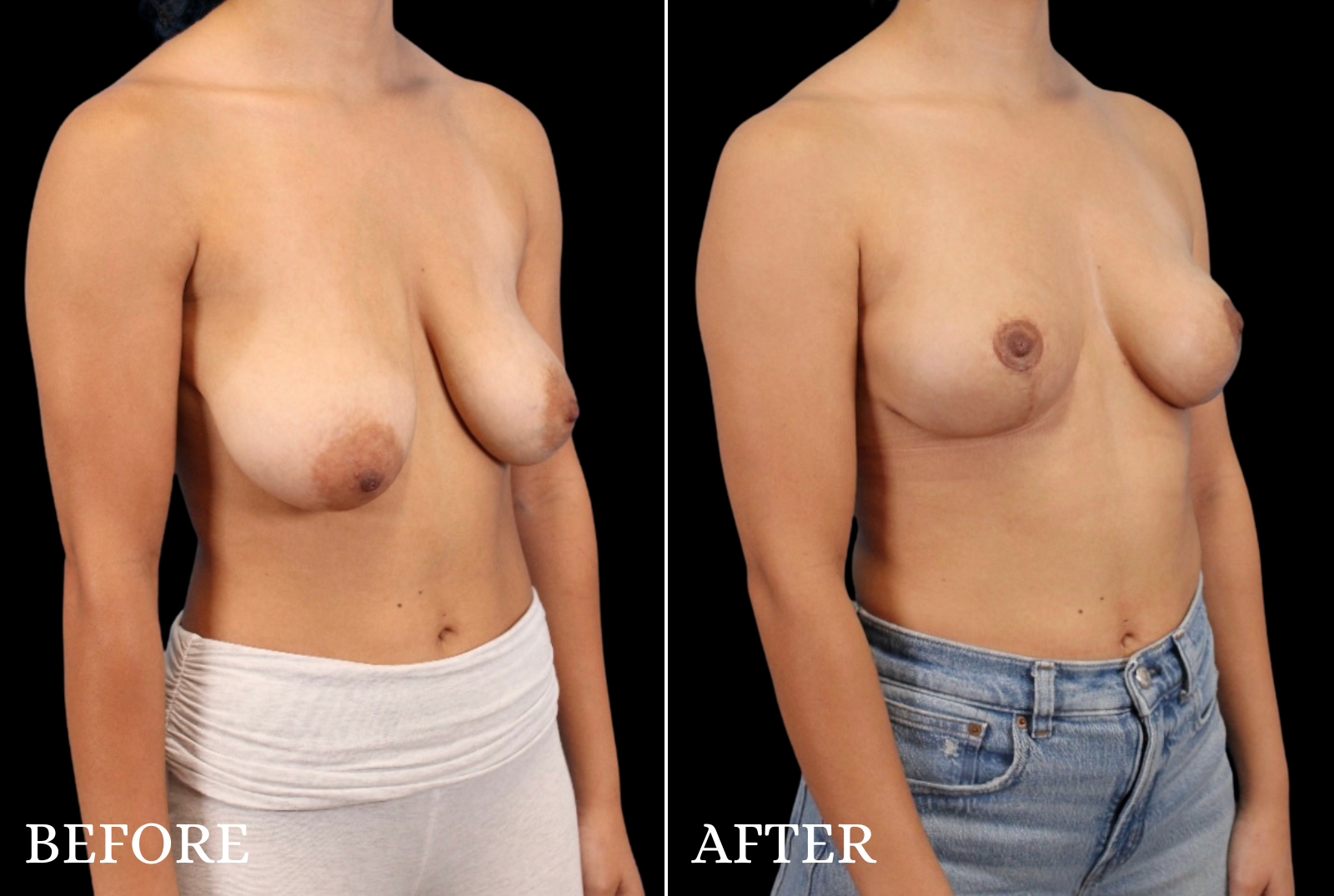 Breast Lift Before & After Gallery - Patient 389430 - Image 5