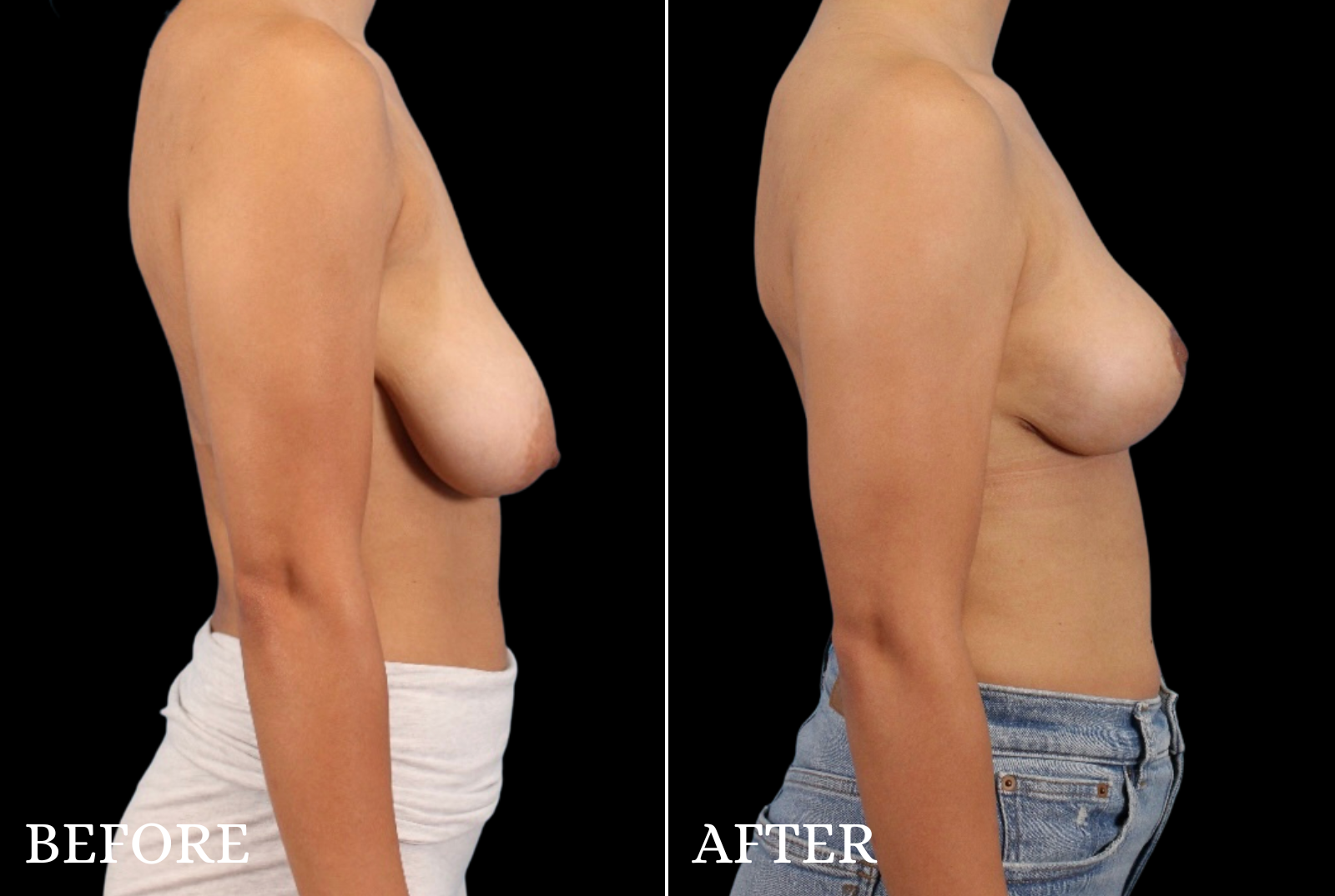 Breast Lift Before & After Gallery - Patient 389430 - Image 4