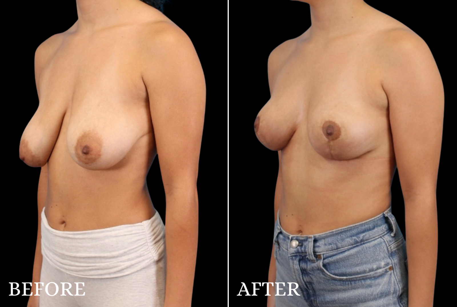 Breast Lift Before & After Gallery - Patient 389430 - Image 2