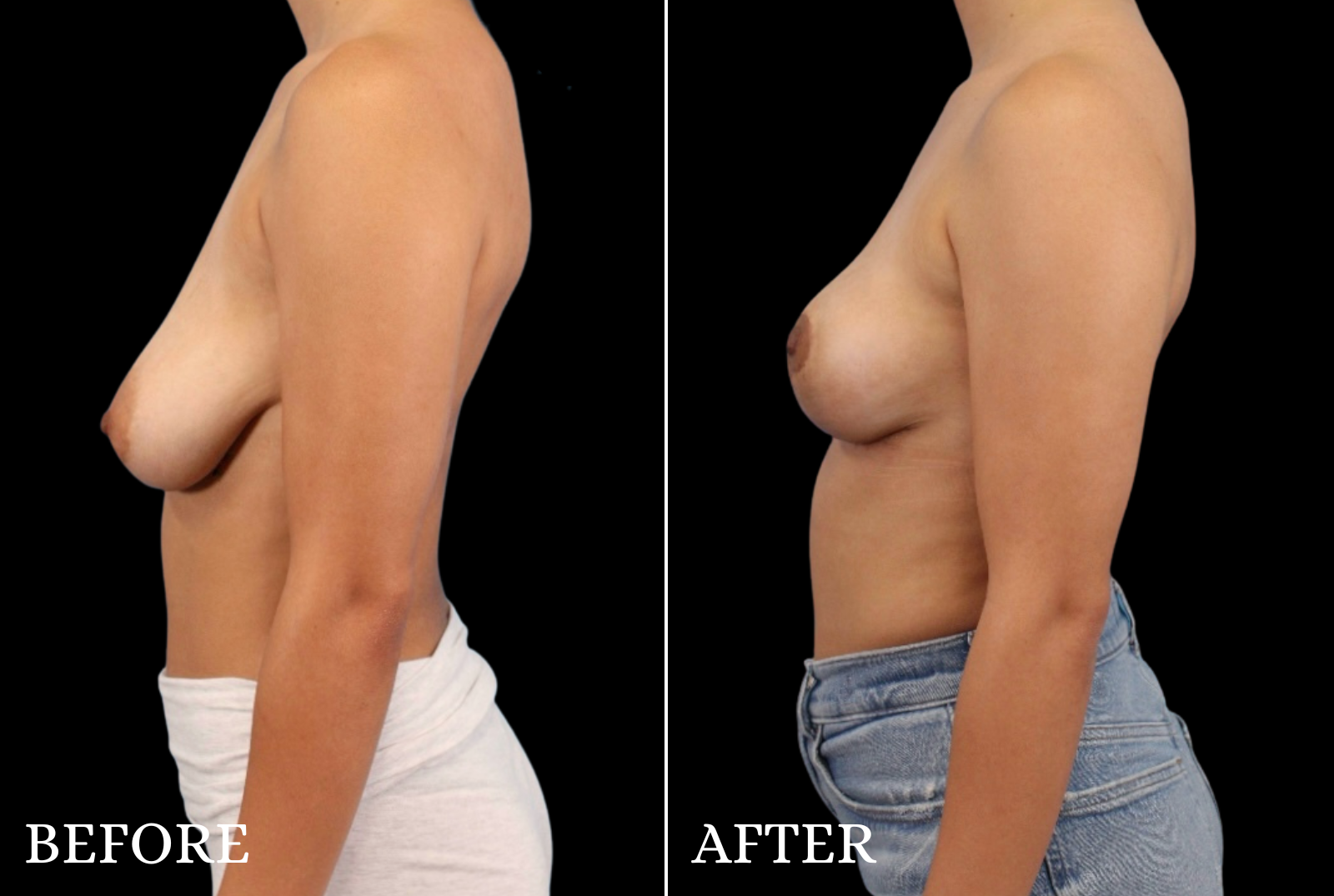 Breast Lift Before & After Gallery - Patient 389430 - Image 3