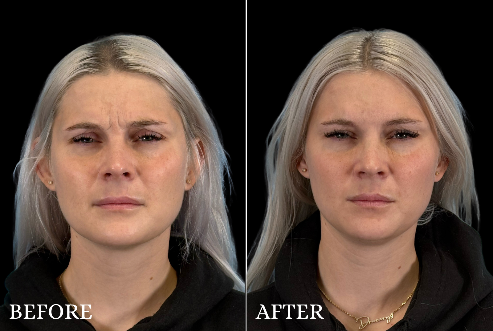 BOTOX/Dysport Before & After Gallery - Patient 113782 - Image 2