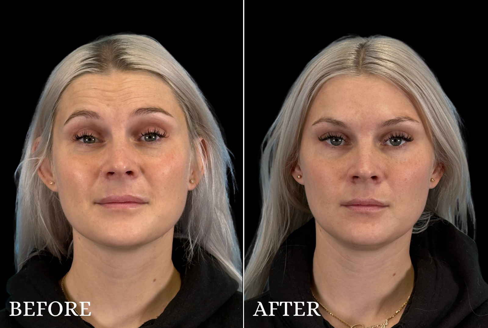 BOTOX/Dysport Before & After Gallery - Patient 113782 - Image 1
