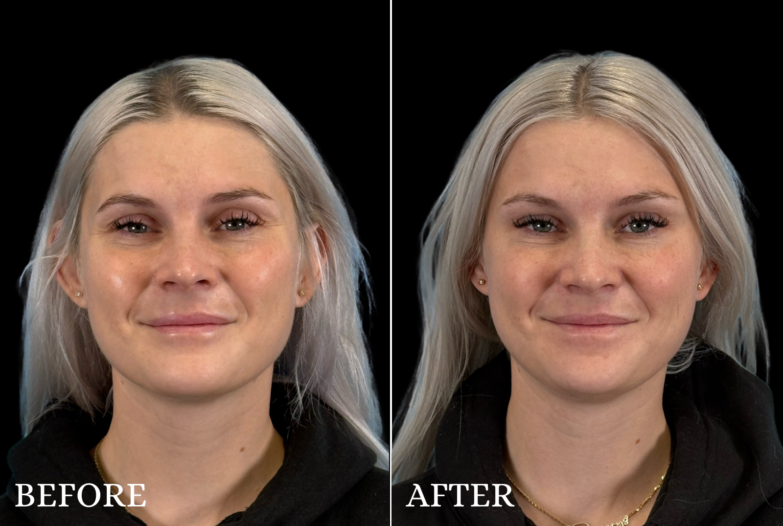 BOTOX/Dysport Before & After Gallery - Patient 113782 - Image 3