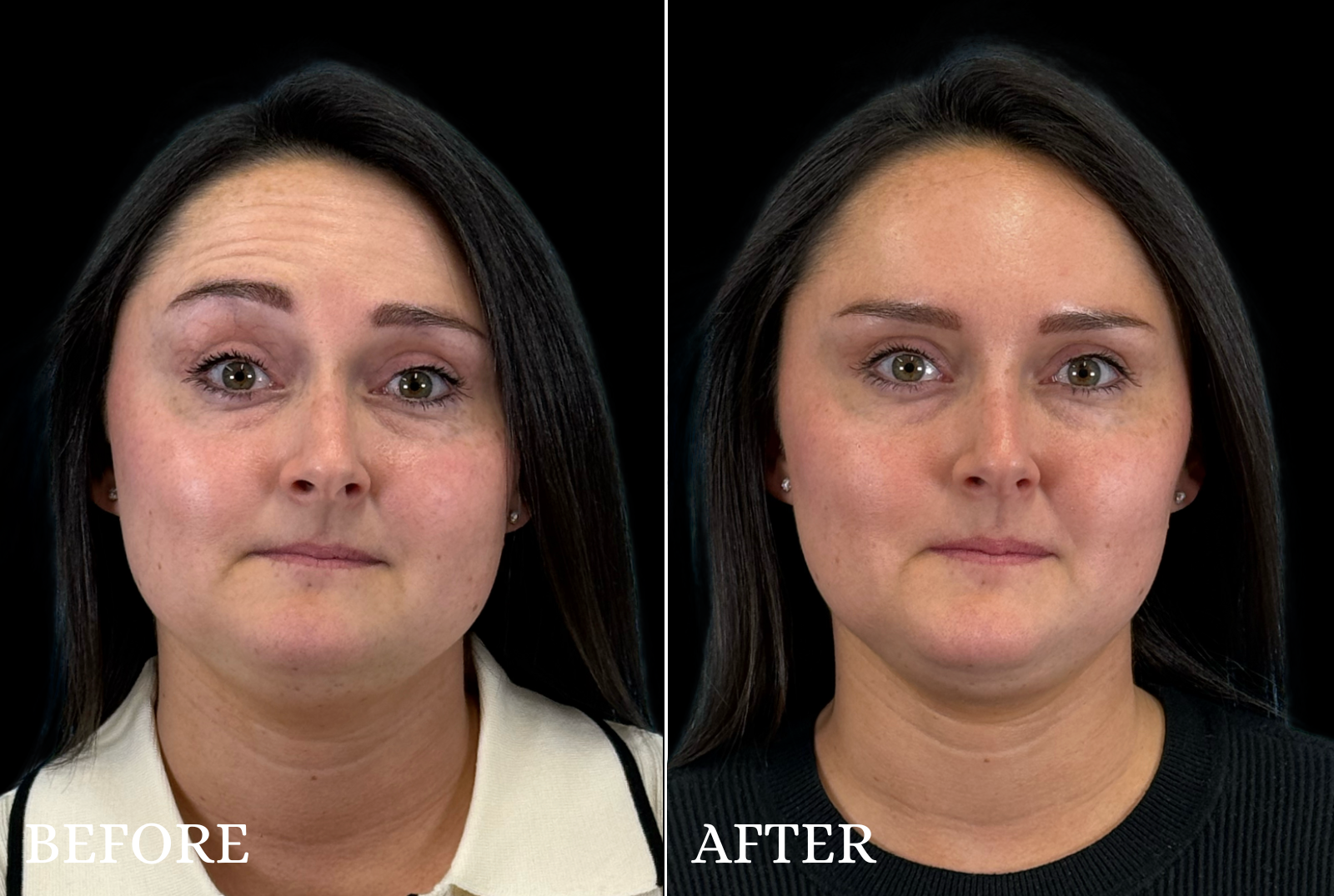 BOTOX/Dysport Before & After Gallery - Patient 303652 - Image 3