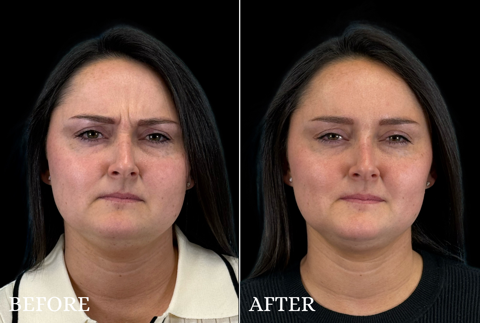 BOTOX/Dysport Before & After Gallery - Patient 303652 - Image 2