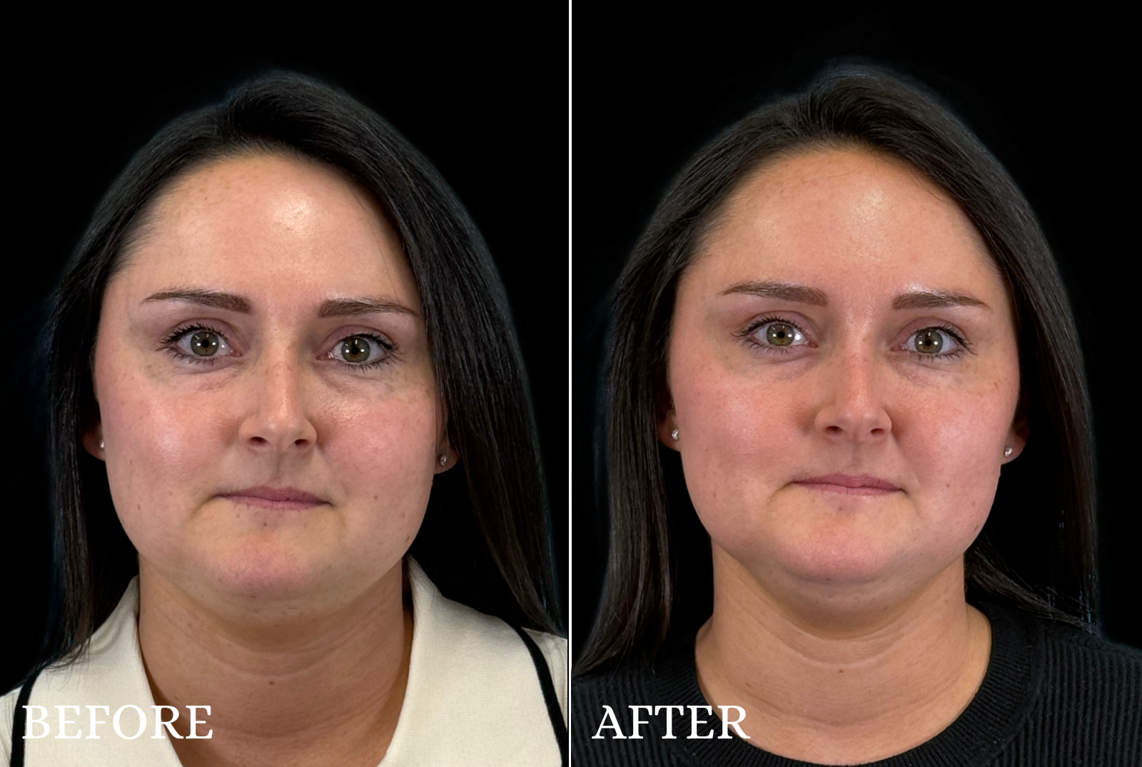 BOTOX/Dysport Before & After Gallery - Patient 303652 - Image 1
