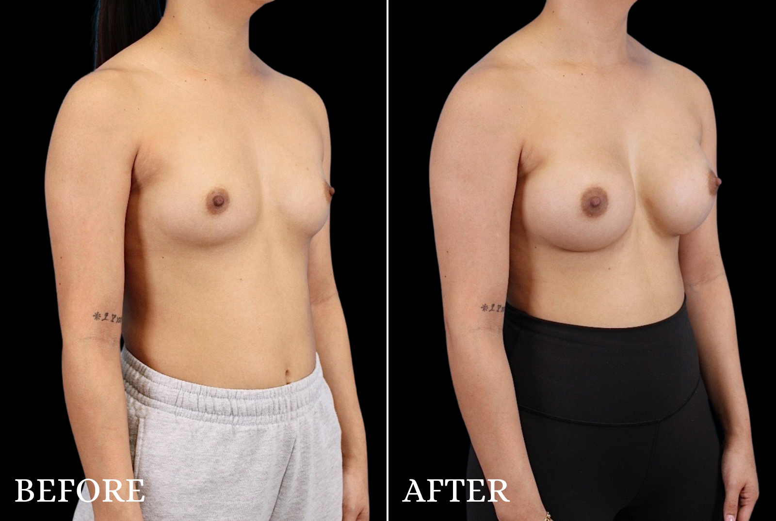 Breast Augmentation Before & After Gallery - Patient 424420 - Image 2