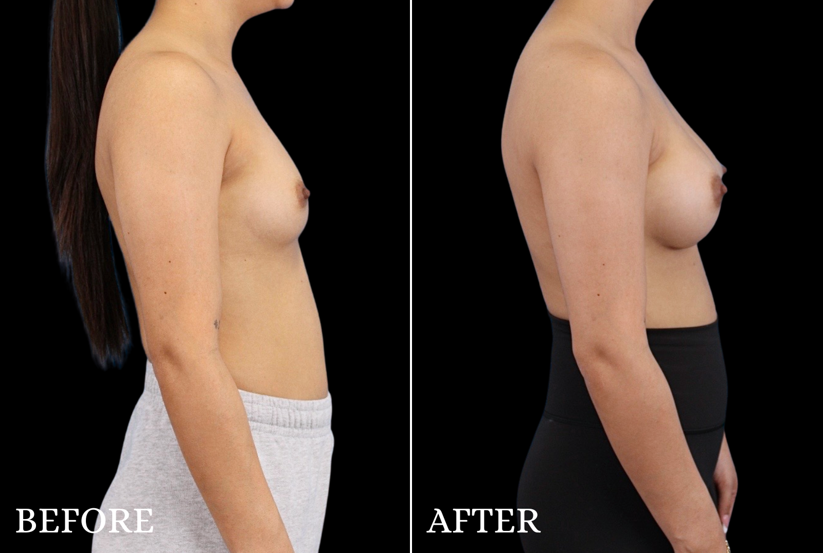 Breast Augmentation Before & After Gallery - Patient 424420 - Image 3
