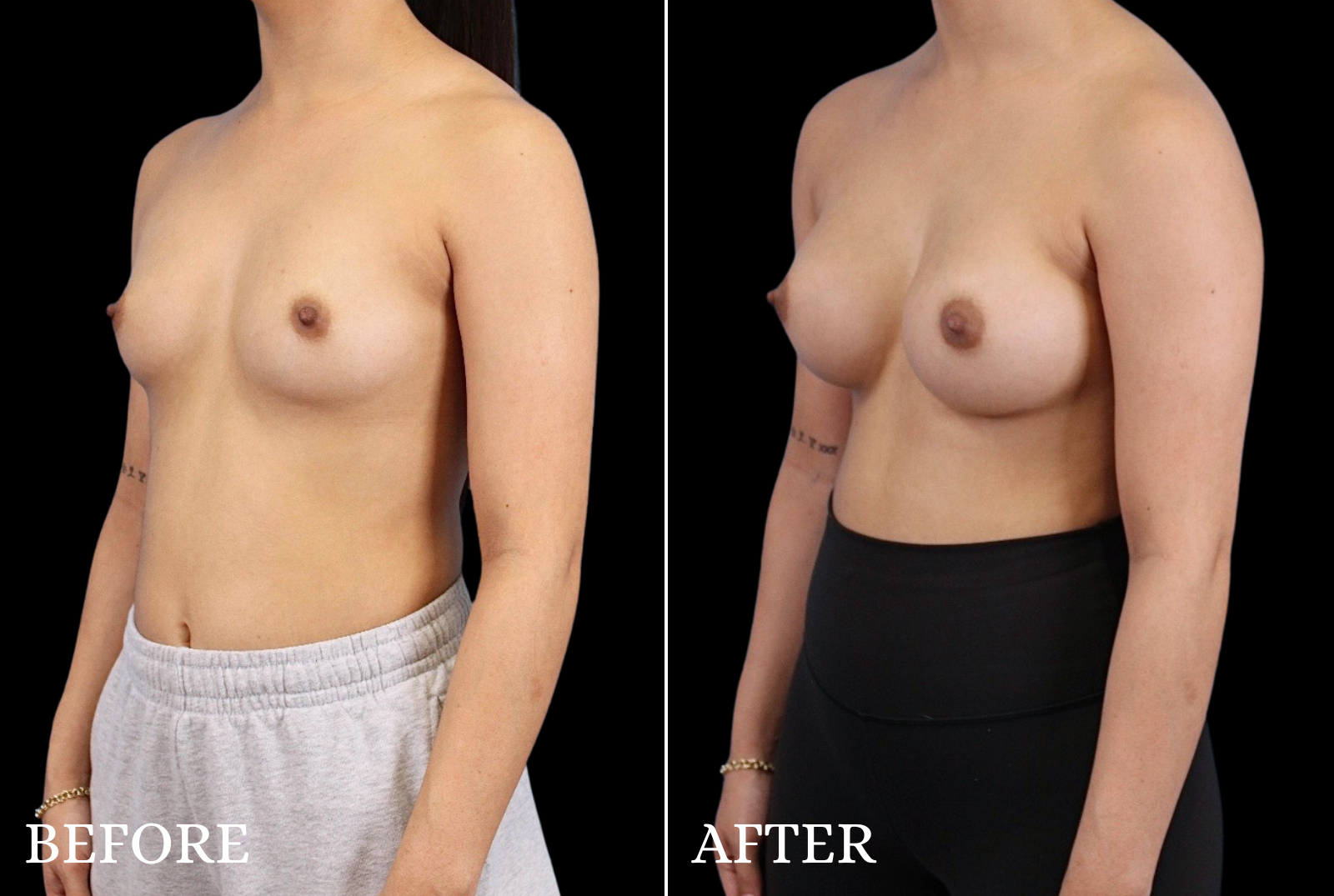 Breast Augmentation Before & After Gallery - Patient 424420 - Image 4