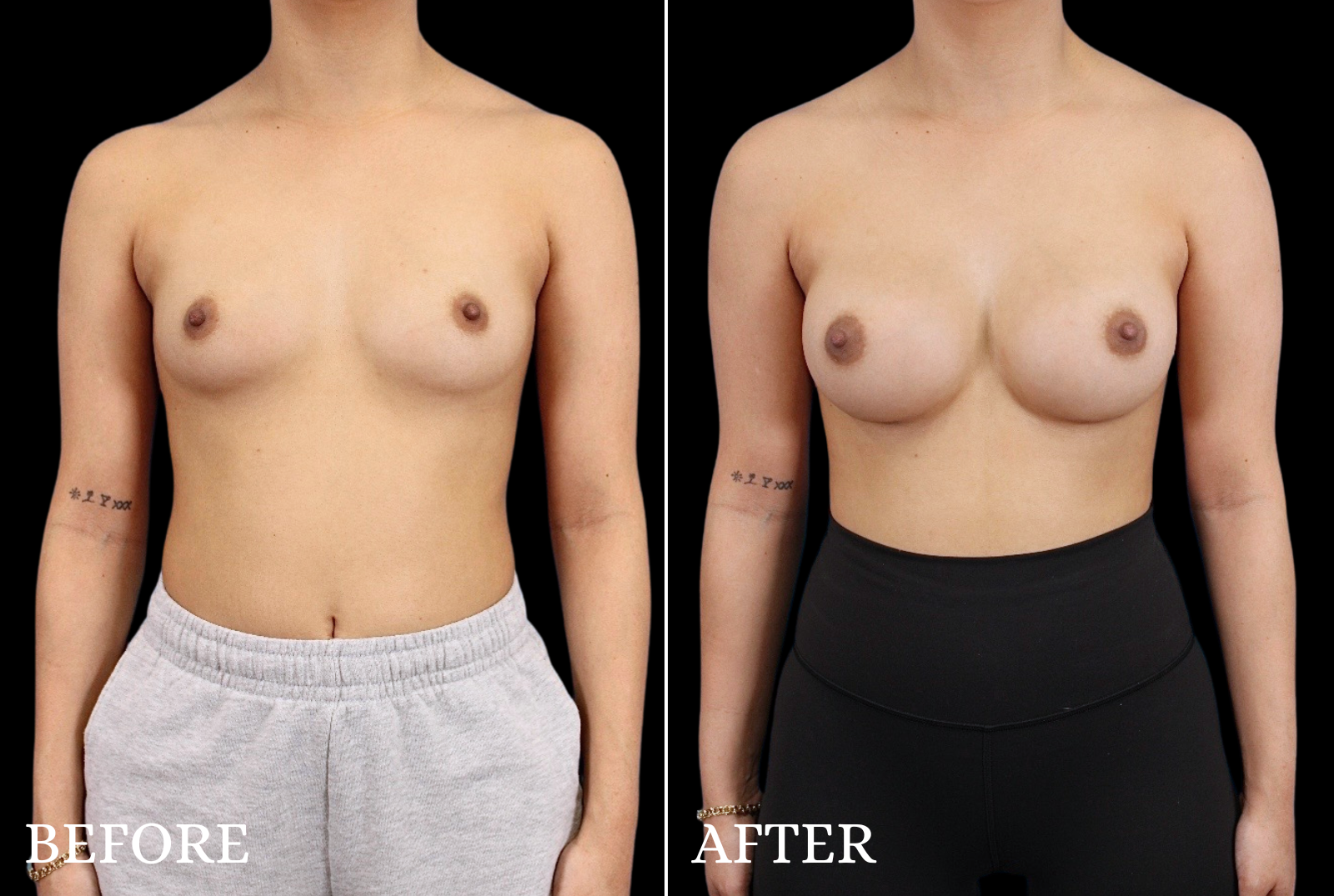Breast Augmentation Before & After Gallery - Patient 424420 - Image 1
