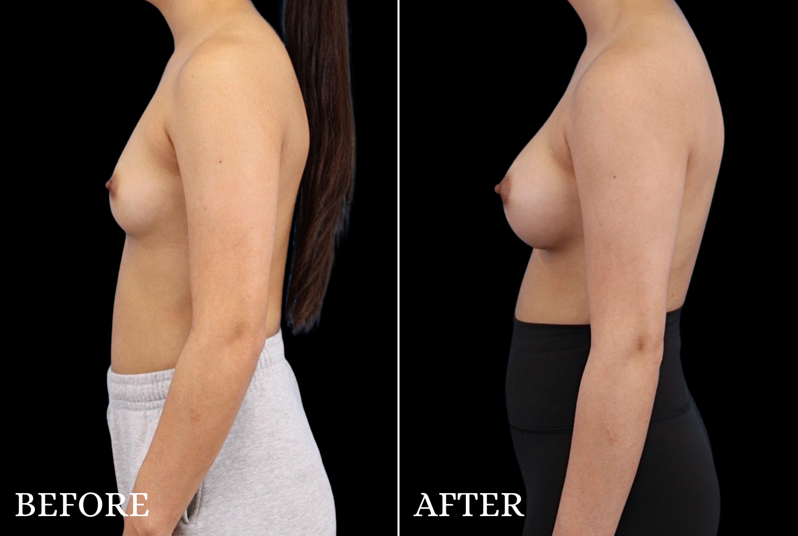 Breast Augmentation Before & After Gallery - Patient 424420 - Image 5