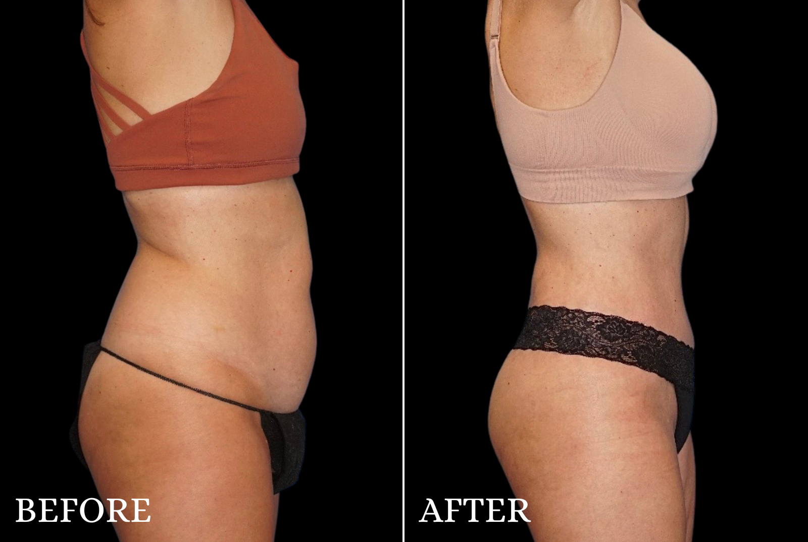 Mommy Makeover Before & After Gallery - Patient 144352 - Image 3