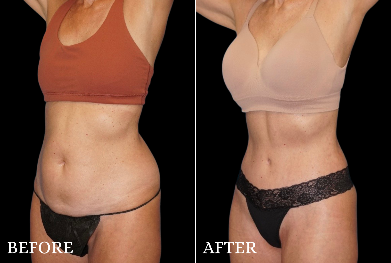 Mommy Makeover Before & After Gallery - Patient 144352 - Image 2