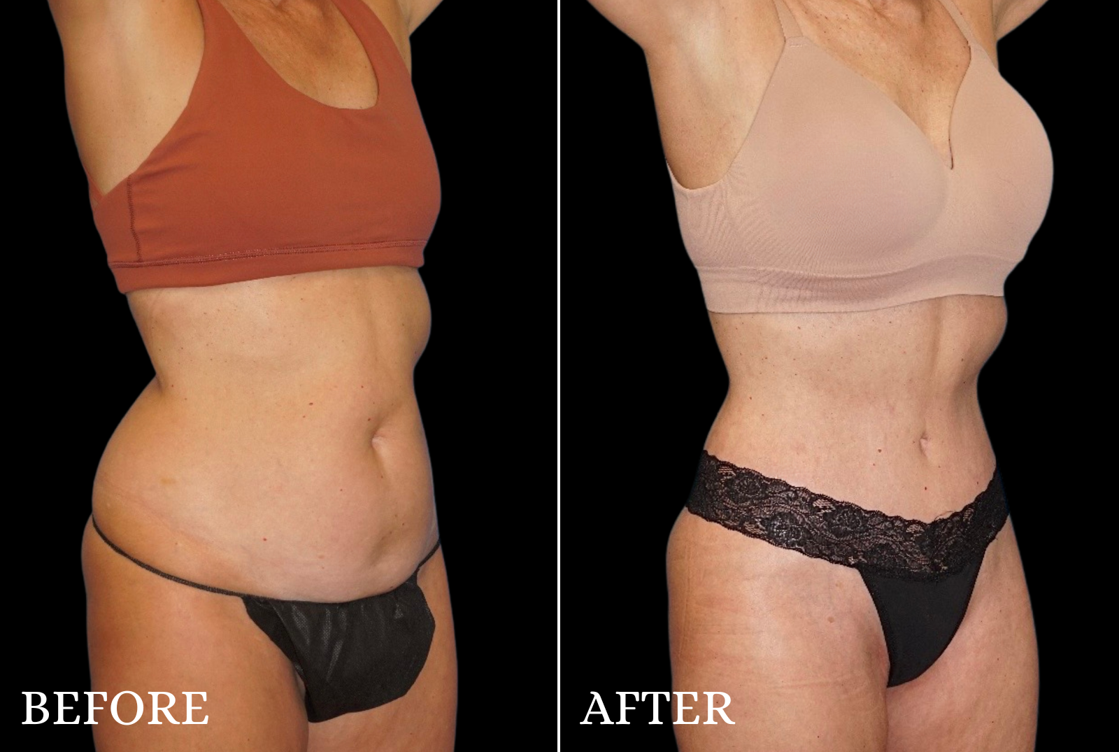 Mommy Makeover Before & After Gallery - Patient 144352 - Image 4