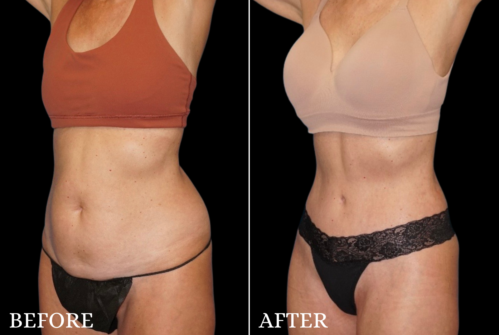 Tummy Tuck Before & After Gallery - Patient 200560 - Image 3