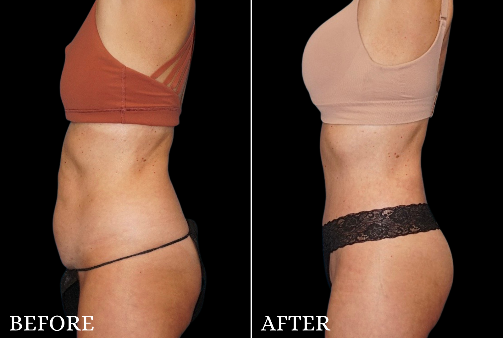 Tummy Tuck Before & After Gallery - Patient 200560 - Image 2