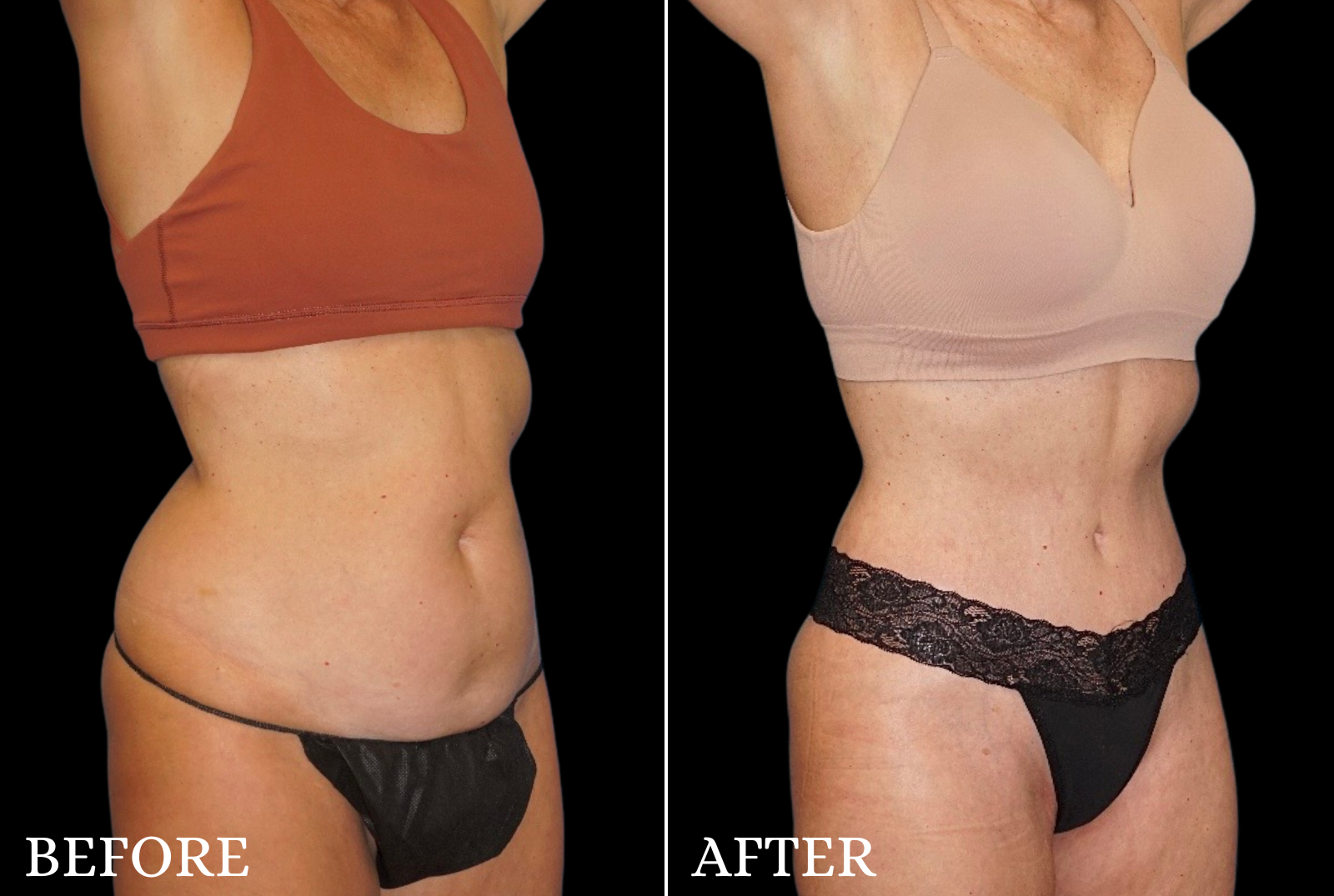 Tummy Tuck Before & After Gallery - Patient 200560 - Image 4