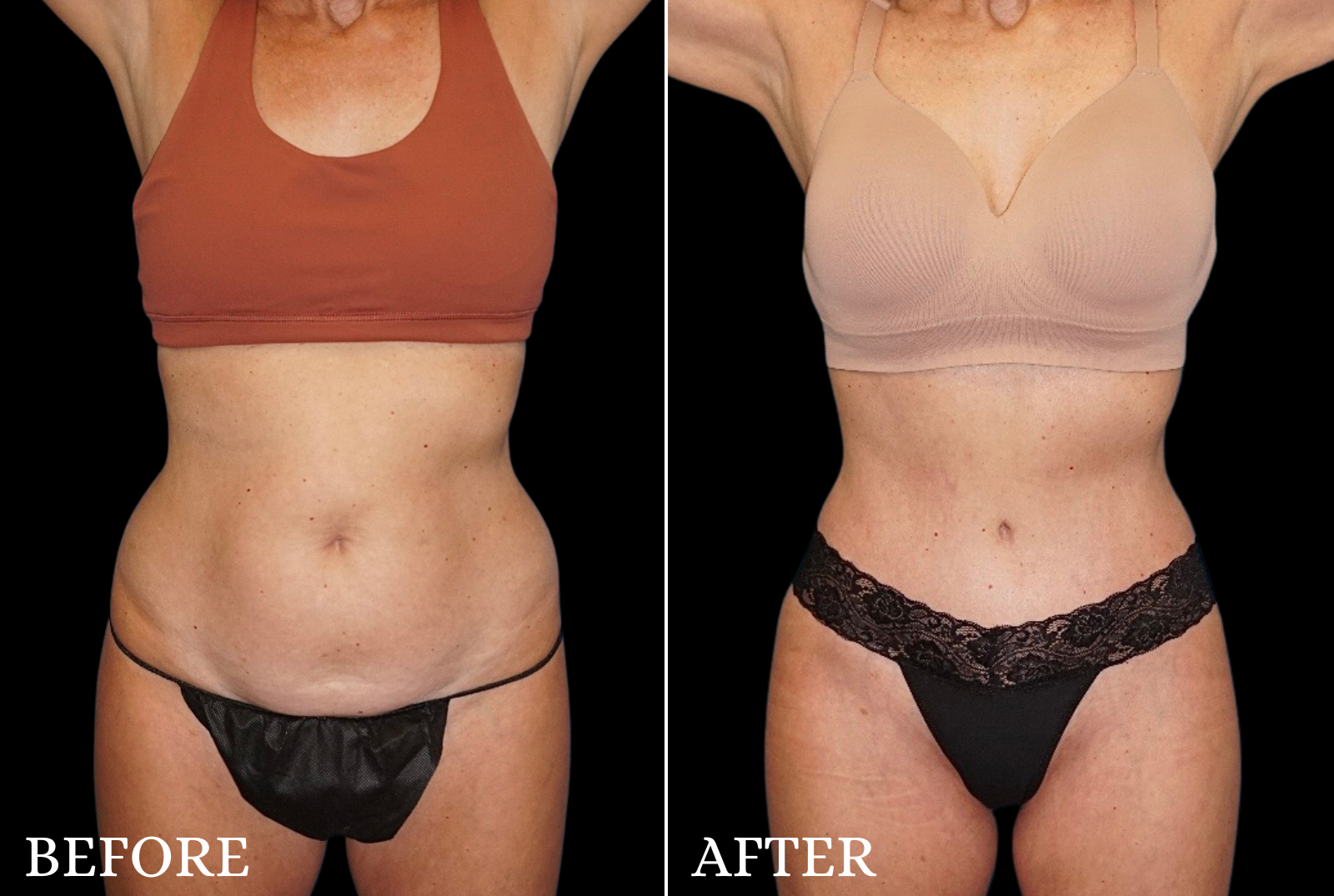 Mommy Makeover Before & After Gallery - Patient 144352 - Image 1