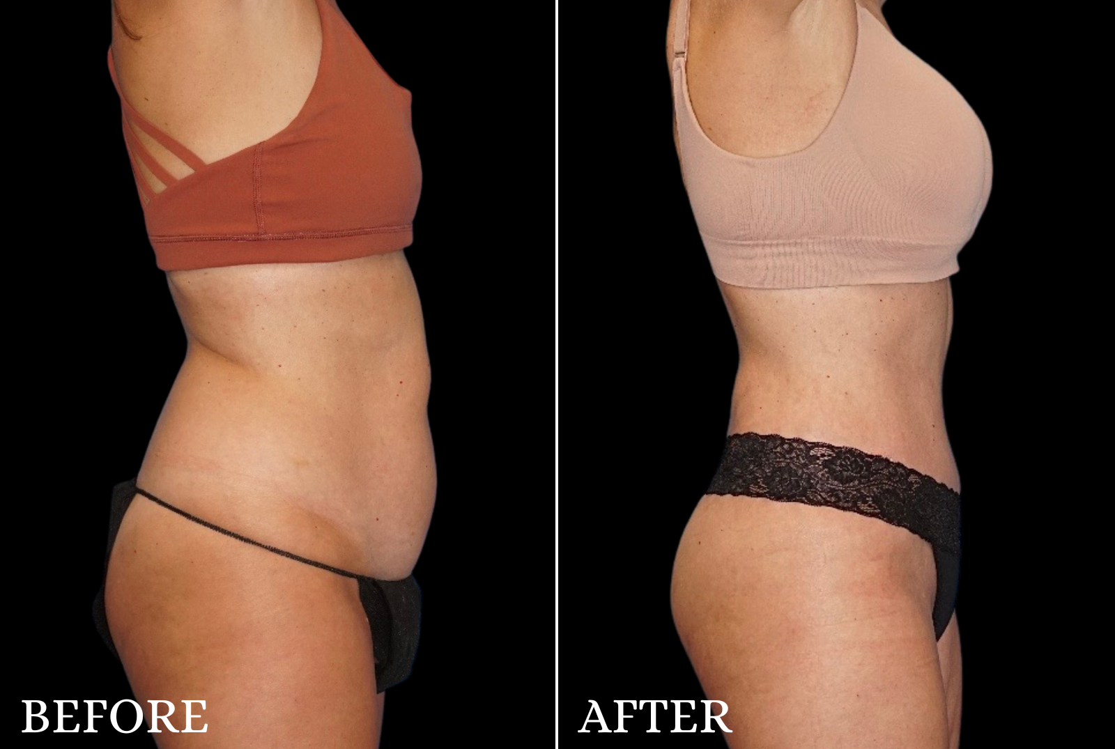 Tummy Tuck Before & After Gallery - Patient 200560 - Image 5
