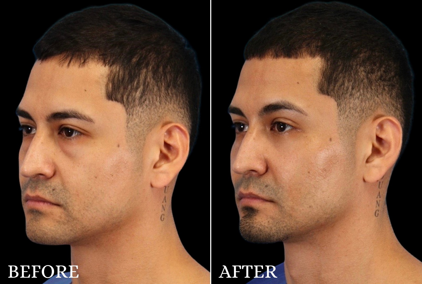 Lower Blepharoplasty Before & After Gallery - Patient 369508 - Image 4