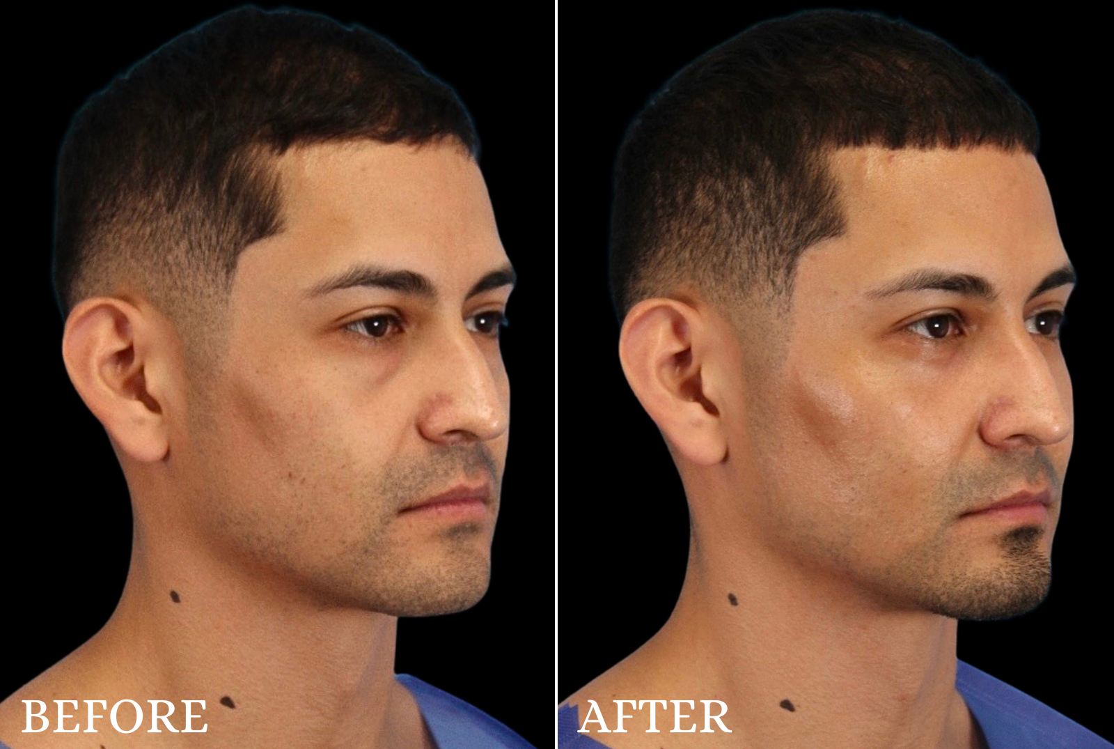 Lower Blepharoplasty Before & After Gallery - Patient 369508 - Image 2