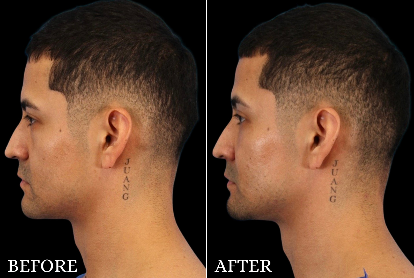 Lower Blepharoplasty Before & After Gallery - Patient 369508 - Image 5