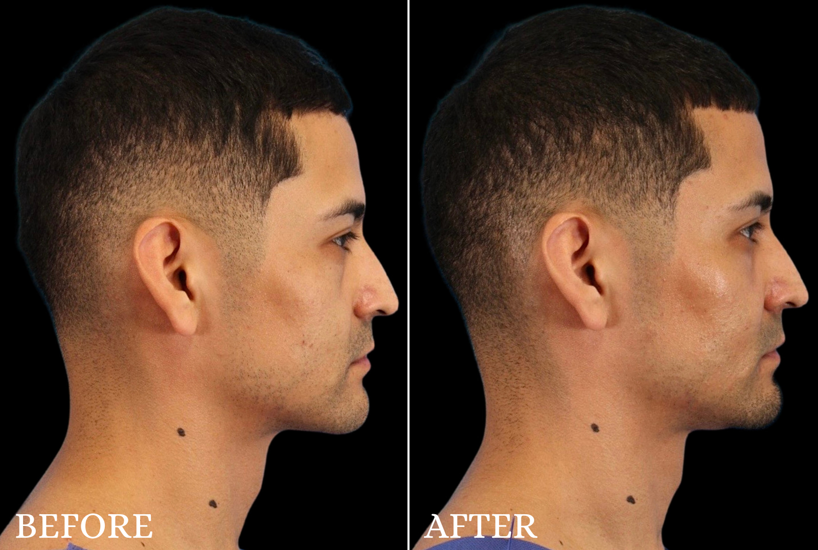 Lower Blepharoplasty Before & After Gallery - Patient 369508 - Image 3