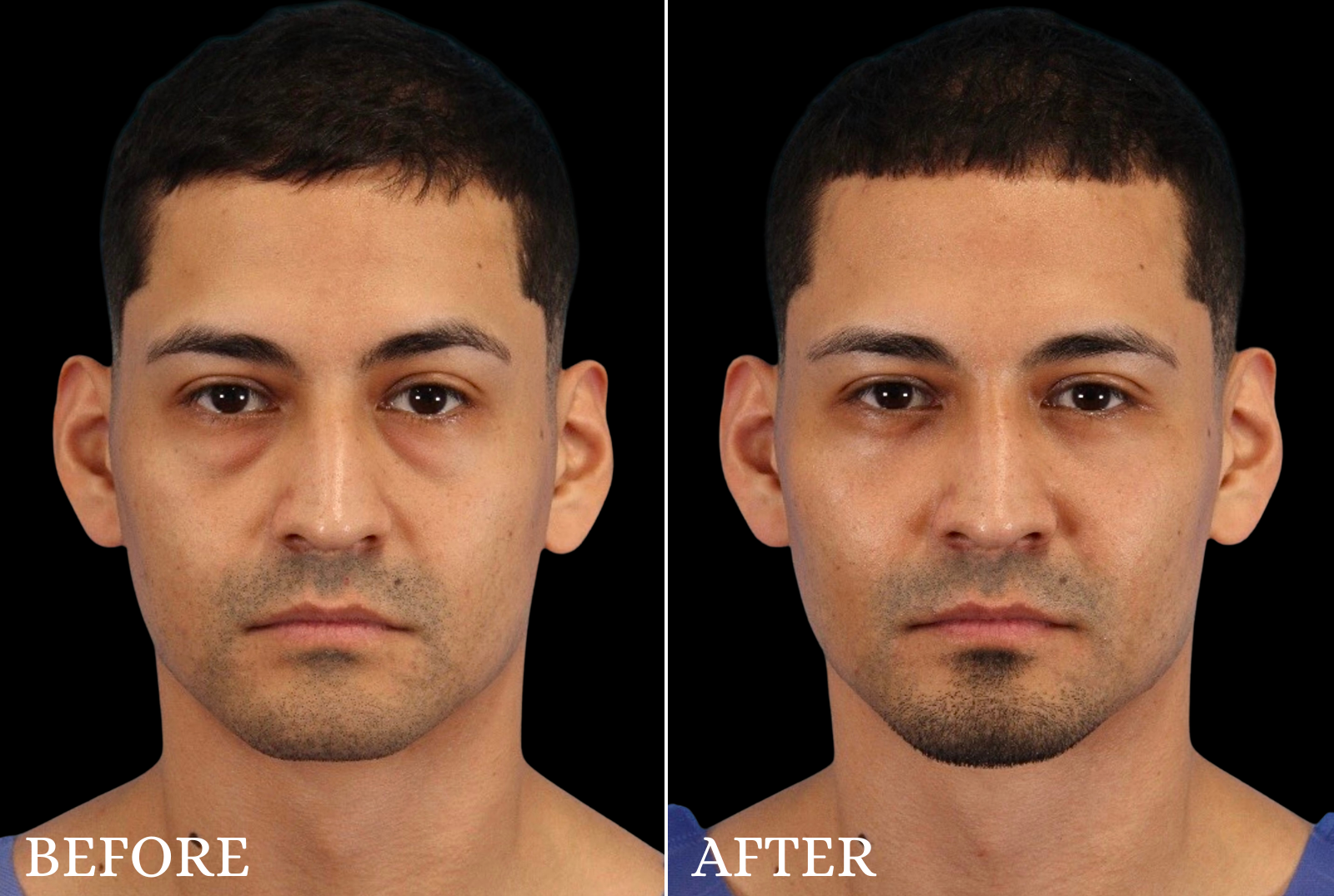 Lower Blepharoplasty Before & After Gallery - Patient 369508 - Image 1