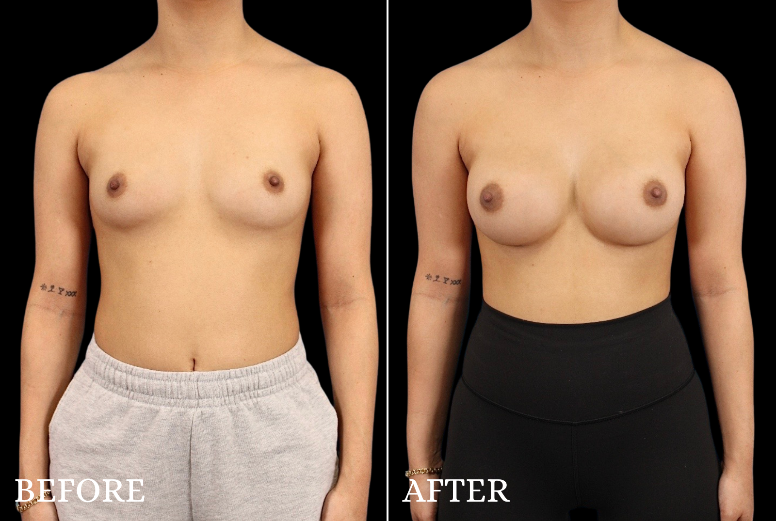 Breast Augmentation Before & After Gallery - Patient 424420 - Image 1