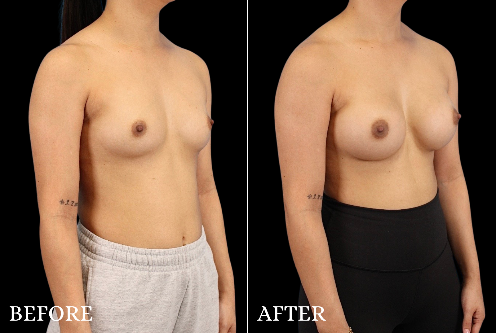 Breast Augmentation Before & After Gallery - Patient 424420 - Image 2