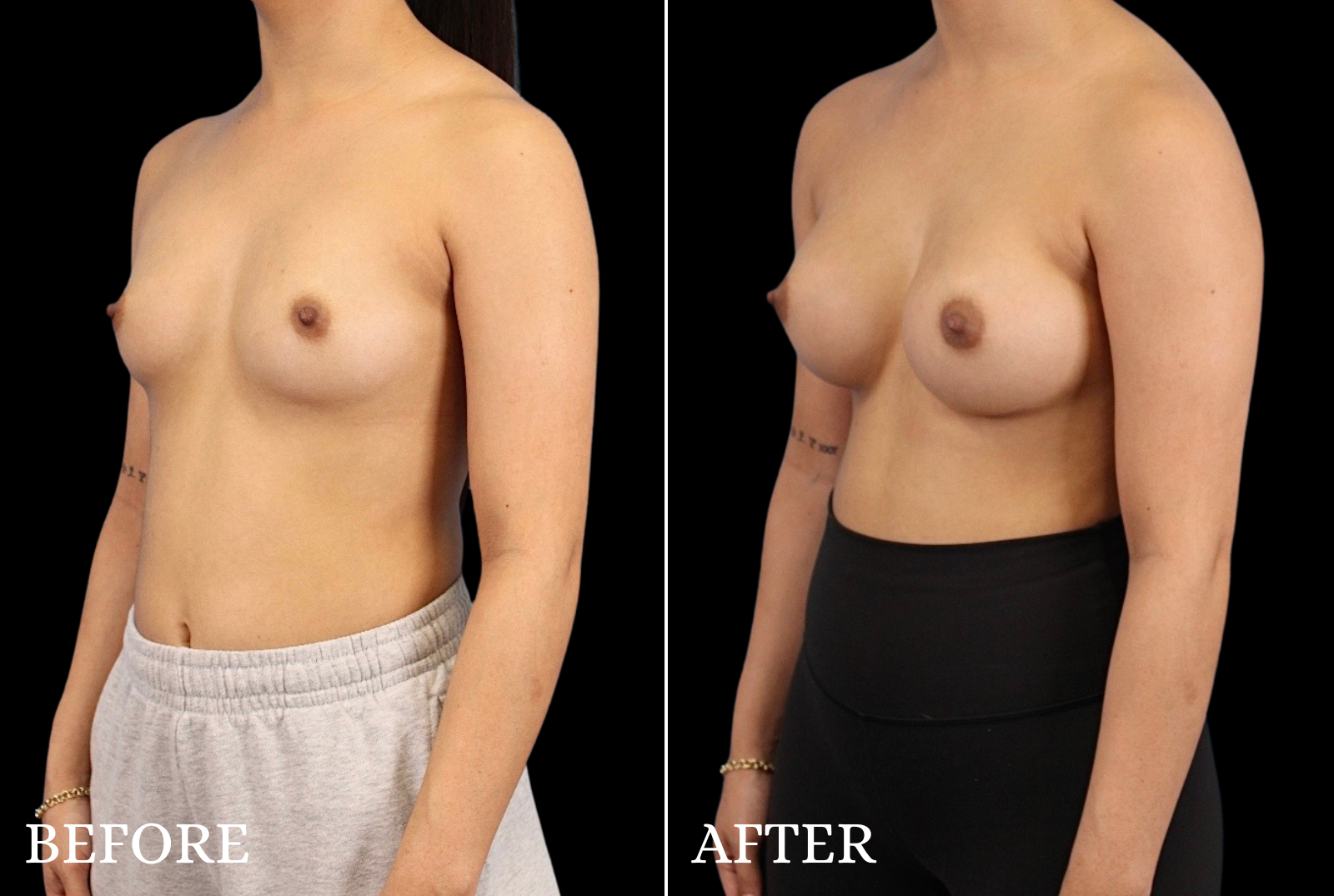 Breast Augmentation Before & After Gallery - Patient 424420 - Image 4