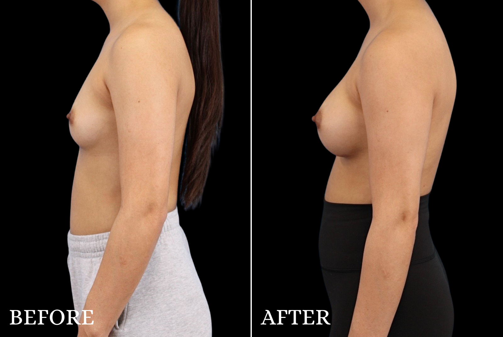 Breast Augmentation Before & After Gallery - Patient 424420 - Image 5