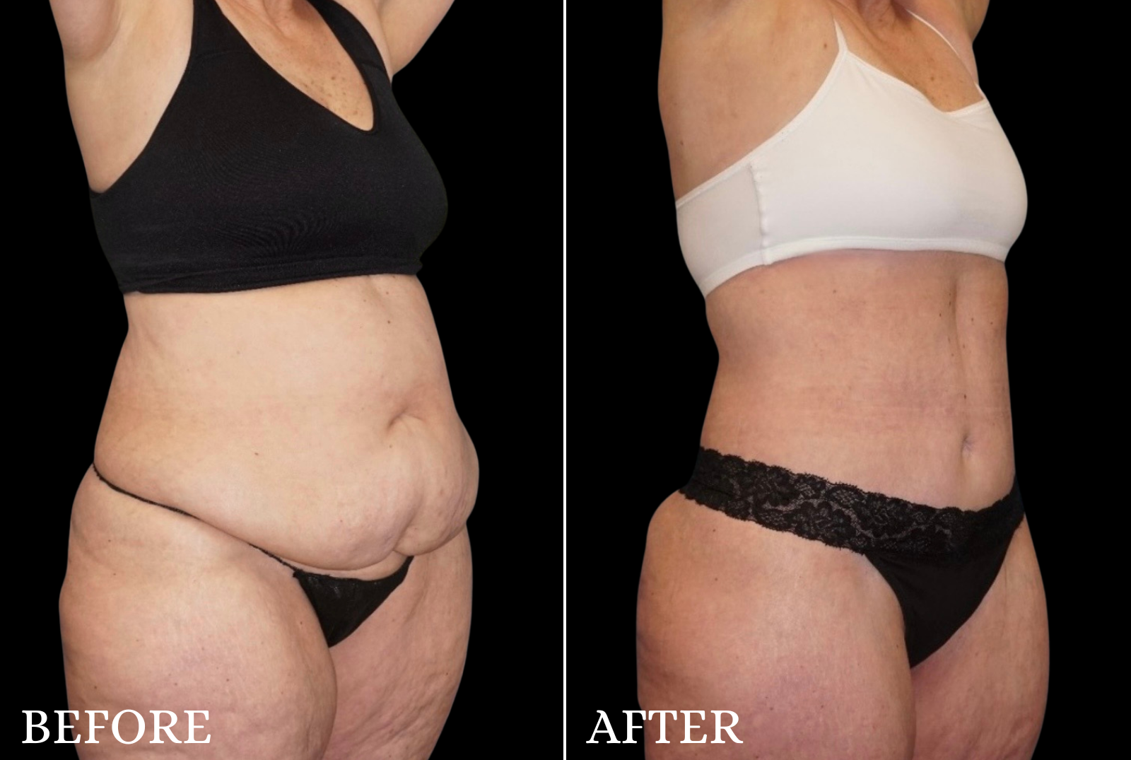 Tummy Tuck Before & After Gallery - Patient 273615 - Image 2