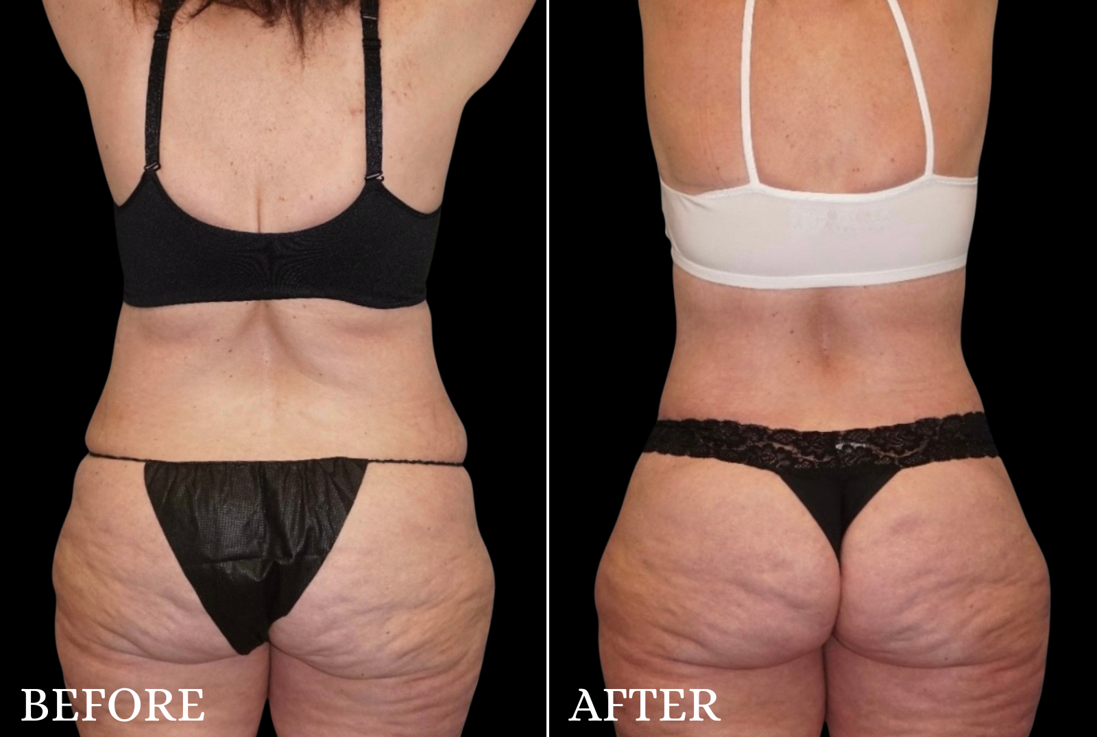 Tummy Tuck Before & After Gallery - Patient 273615 - Image 4