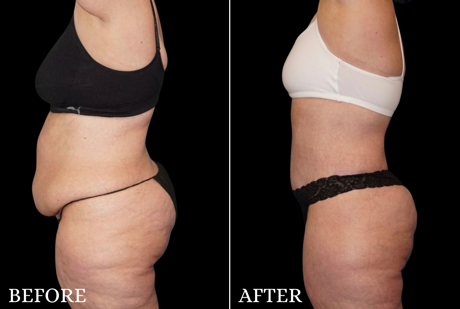 Tummy Tuck Before & After Gallery - Patient 273615 - Image 6