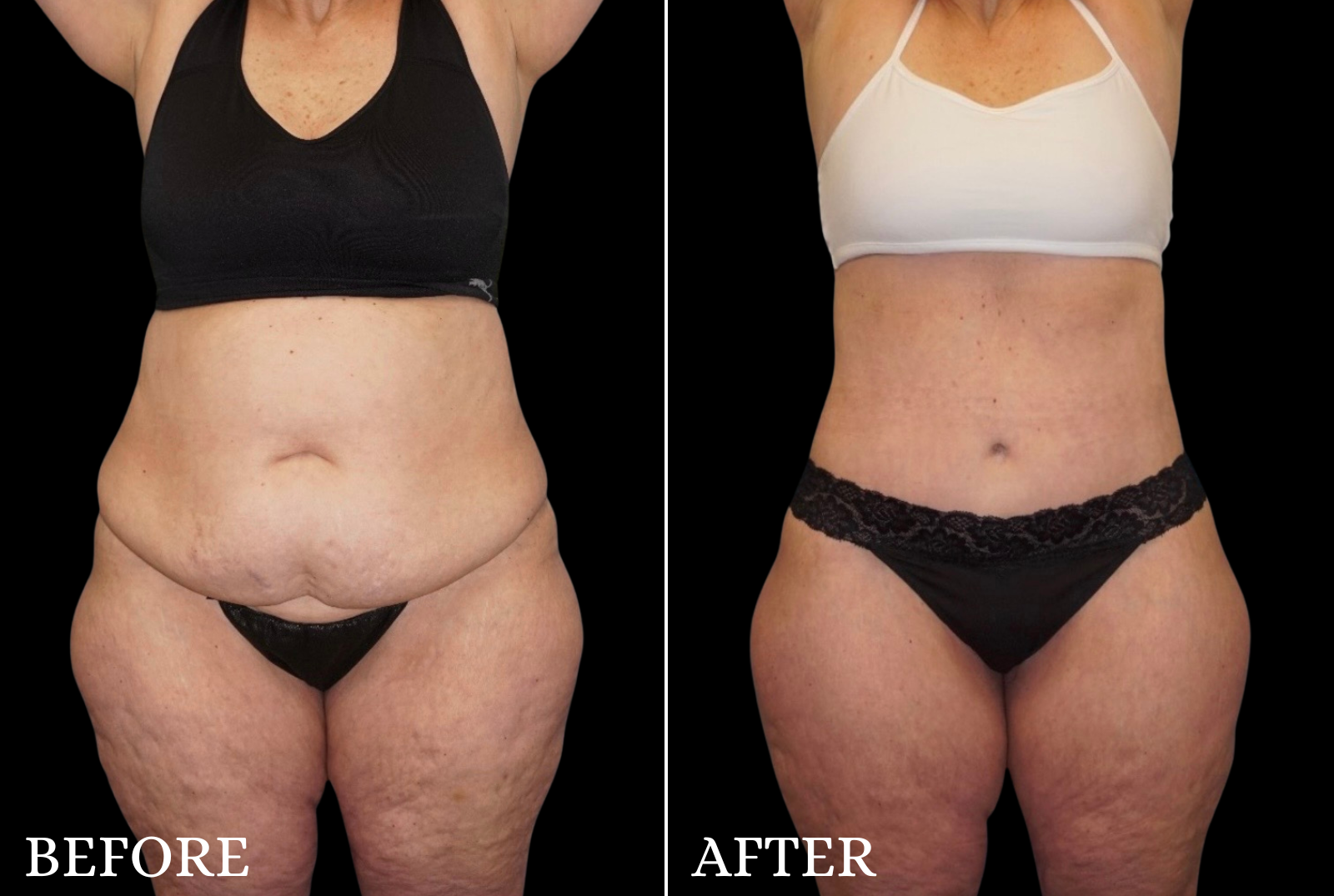Tummy Tuck Before & After Gallery - Patient 273615 - Image 1
