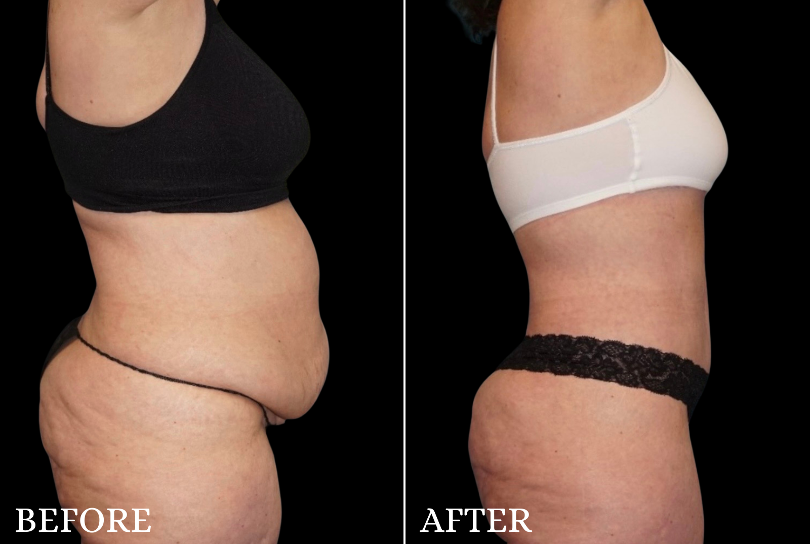 Tummy Tuck Before & After Gallery - Patient 273615 - Image 3