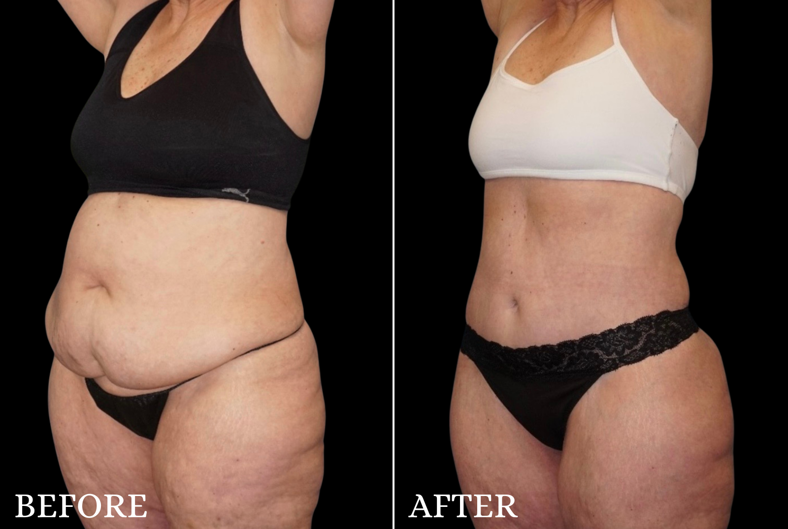 Tummy Tuck Before & After Gallery - Patient 273615 - Image 5