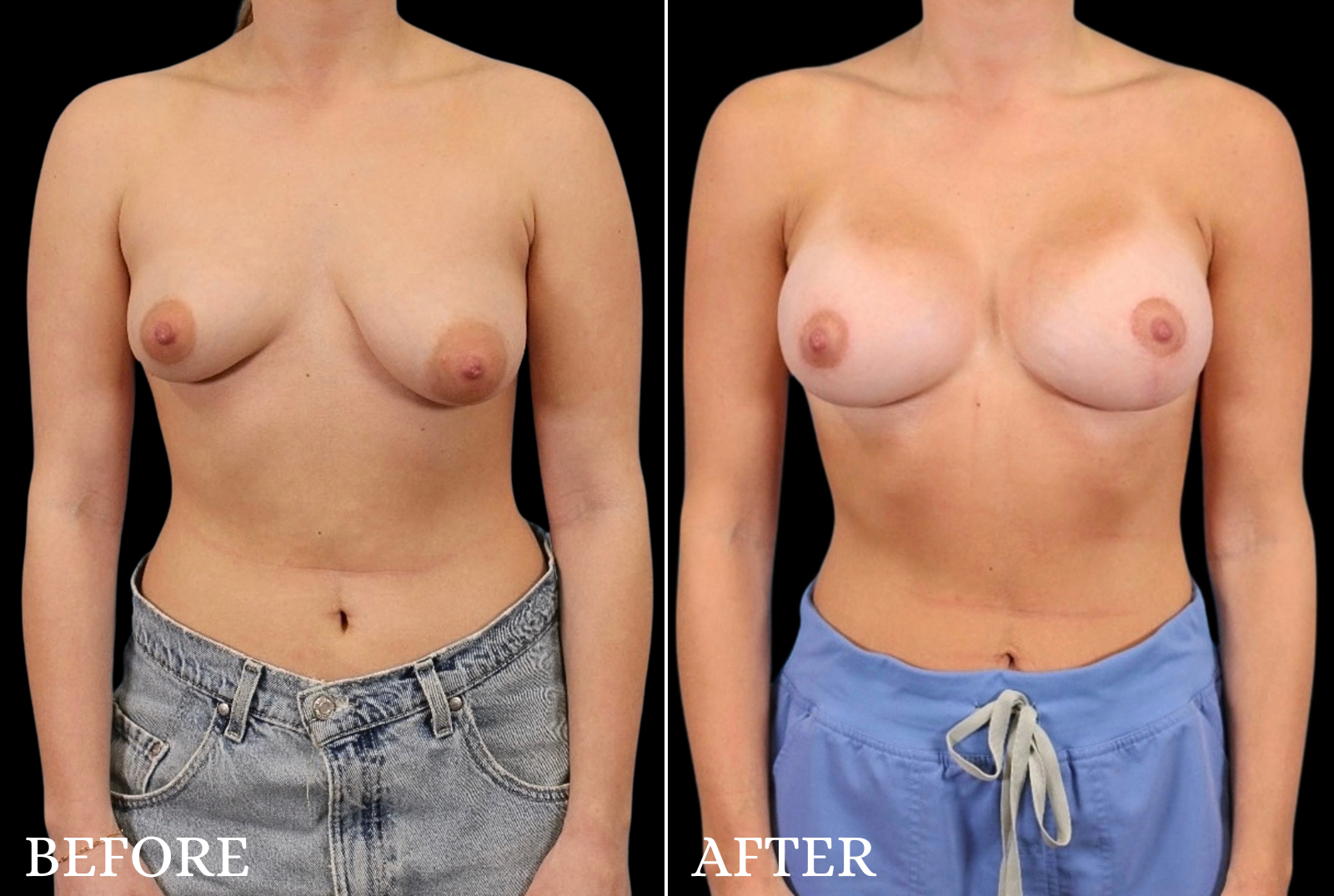 Breast Lift with Implant Before & After Gallery - Patient 163389 - Image 1