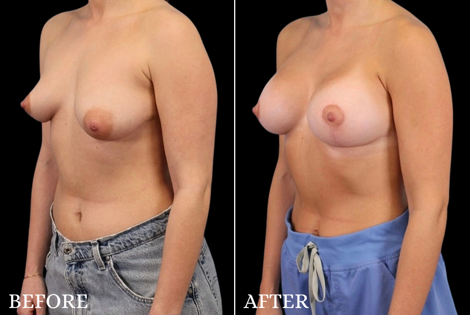 Breast Lift with Implant Before & After Gallery - Patient 163389 - Image 4