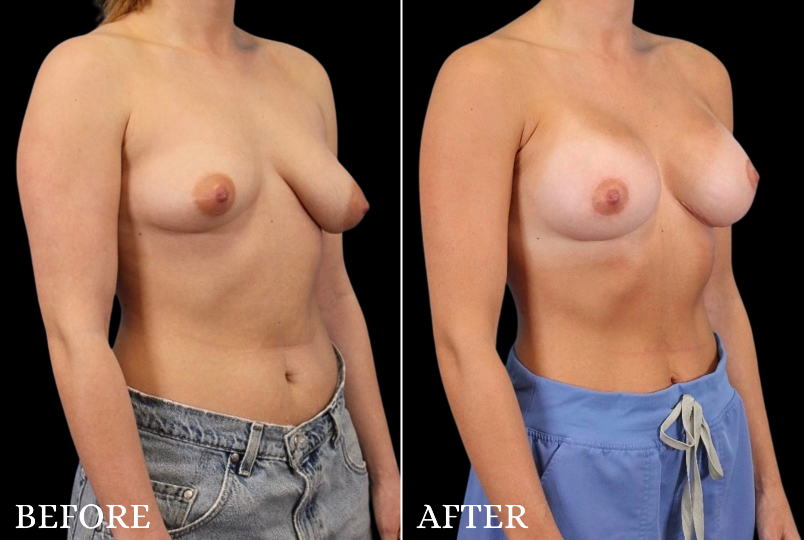 Breast Lift with Implant Before & After Gallery - Patient 163389 - Image 2